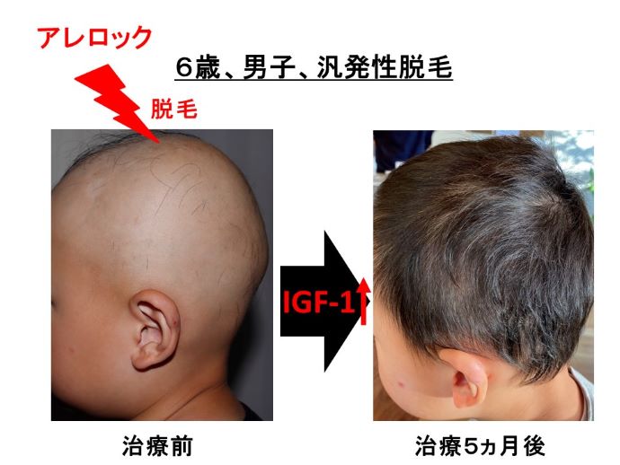 円形脱毛症　病院